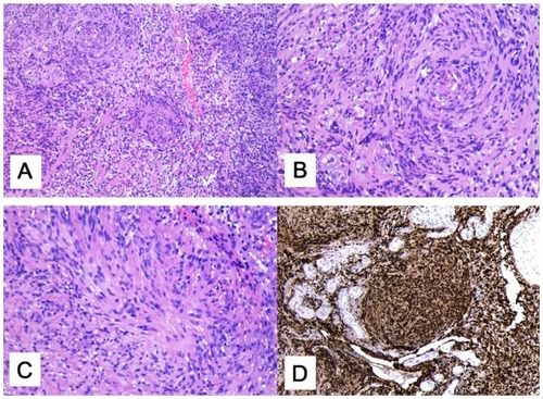 Figure 3 Histological findings. (A) Biphasic pattern mainly with Antoni A and few hypocellular, Antoni B, areas (x100). (B–C) Higher magnification of Antoni A areas (x200). (D) S-100 protein positivity of the elongated tumor cells (x200).
