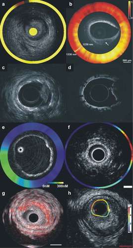Figure 2. Output of the available hybrid imaging catheters: (a) combined NIRS-IVUS imaging, IVUS enables assessment of the lumen, outer vessel wall dimensions and plaque burden while NIRS allows detection of the lipid component indicated with a yellow-orange color; (b) a typical example of a combined OCT-NIRS image where spectroscopy enables reliable characterization of the composition of the plaque – the tissue extending from 4–7 o’clock could have been classified as calcific tissue according to standalone OCT, nevertheless NIRS demonstrates an increased lipid component – and classifies the plaque as fibroatheroma; (c, d) output of the combined IVUS-OCT catheter: (c) IVUS allows assessment of stent expansion and quantification of the lumen, stent, outer vessel wall dimensions and plaque burden behind the stent, while (d) OCT enables detailed assessment of stent apposition, strut endothelisation, and detection and classification of the endoluminal thrombus; (e) hybrid OCT-NIRF imaging performed after injection of the Prosense VM110 activatable marker, OCT allows visualization of plaque characteristics while NIRF identifies the presence of cathepsins B which indicate increased protease activity and inflammation; (f) combined IVUS-NIRF imaging after injection of the indocyanin green tracer which indicates macrophages accumulation; (g) hybrid IVUS-IVPA imaging, IVPA allows reliable detection of lipid component – indicated with orange color – while IVUS allows assessment of the lumen and plaque morphology; and (h) hybrid IVUS-TRFS imaging. TRFS provides assessment of the superficial plaque components and detection of collagen (orange color), macrophages and lipid component (green color) while IVUS allows visualization of the lumen and quantification of the plaque burden. Images modified and obtained with permission from Bourantas et al [Citation62] and Abran et al [Citation84]. Full color available online.