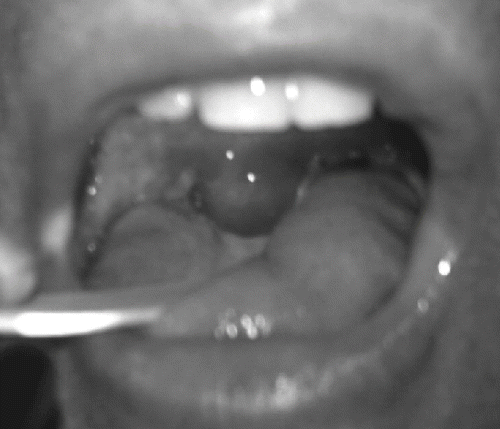 Fig. 1.  Severe uvular edema due to the undiluted form of Ecbalium elaterium juice.