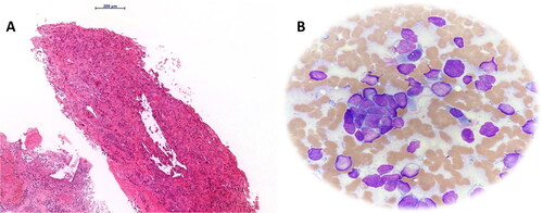 Figure 2. (A) Transbronchial biopsy of the identified lung mass revealed a cellular neoplasm composed of the large neoplastic cells with moderate to marked nuclear atypia, arranged in glandular, acinar and solid growth patterns (hematoxylin and eosin stain, magnification 10×); (B) a smear of the punctate showing aggregates and single small neoplastic cells with scanty basophilic cytoplasm and hyperchromatic nuclei without prominent nucleoli, consistent with SCLC morphology (May Grunwald-Giemsa stain, magnification, 40×).