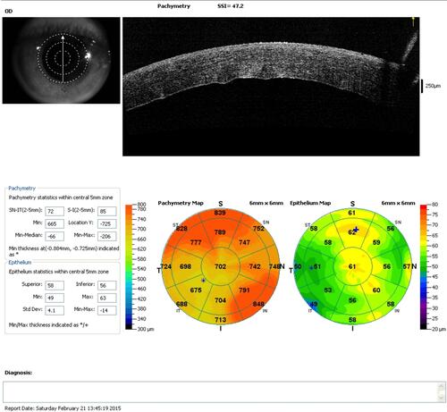 Figure 1 SD-OCT of one patient on the first postoperative day, showing both epithelial and corneal thickness maps, with significant increase in thickness.