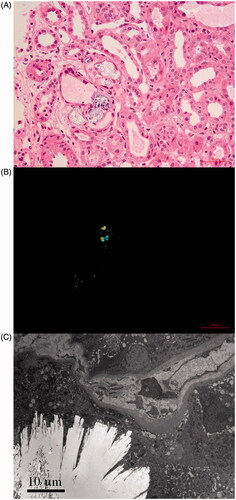 Figure 1. Renal oxalate crystal deposit. (A) Transparent or light brown crystal structures can be seen under light microscope (HE, ×400). (B) Birefringent crystals can be seen under polarized light microscope (HE, ×400). (C) Clusters of needlelike crystal structures under electron microscope (×3000).