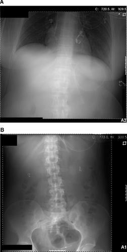 Fig. 2.  (A, B) Abdominal X-rays from the patient's third overdose episode, taken approximately 11 h after the first X-ray. No capsules were visible in the gastrointestinal tract.