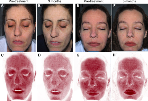 Figure 4 Topographic skin complexion analysis using the Reveal imaging system. Cross polarized (A, B, E and F) and RBX Red (C, D, G and H) images are displayed. Patients presented noticeable improvement in the underlying vascular condition after ES therapy.