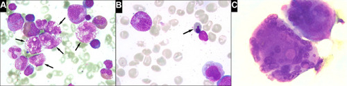 Figure 3 Bone marrow aspirate smear (2018). (A) Giant hypersegmented hypergranular neutrophilic cells (arrows). (B) Nuclear fragmentation of an erythroid precursor (arrow). (C) Abnormal megakaryocytes displaying multiple separated nuclei. Romanowsky, x1000.