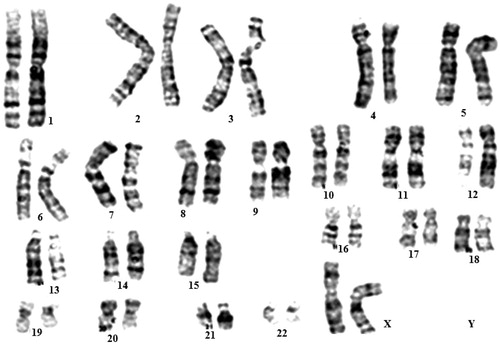 Figure 1. Karyotype analysis of eyelid fat derived stem cells (EFDSCs) cultured on nanofibrous substrate. All stem cells at seven passages represented a normal 46XX karyotype.