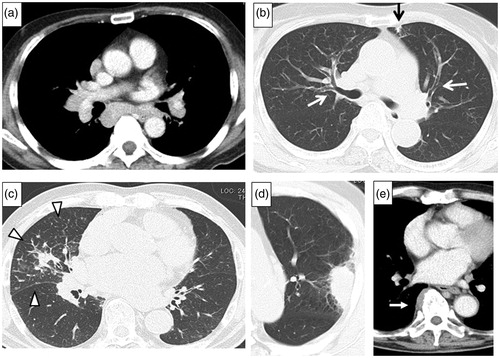 Figure 1. Chest CT scans of IgG4-RRD, showing. (a) Mediastinal lymphadenopathy. (b) Bronchial thickening in both upper lobes (white arrows), subpleural small consolidation in the left upper lobe (black arrow). (c) Interlobular thickening and infiltrative shadow in the right middle lobe (white arrowheads). (d) Mass-like consolidation in the left upper lobe. (e) Paravertebral thickening in the right lower lobe (white arrow).