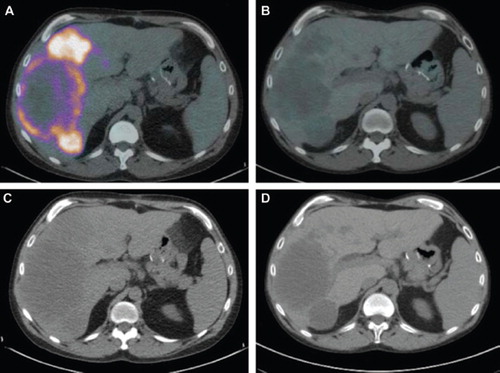 Figure 1. Patient 1. PET scan from (A) May 2009 showing a maximum SUV uptake value of 9.28 and (B) June 2010 with a maximum SUV uptake value of 2.12. CT scan from (C) May 2009 and (D) June 2010.