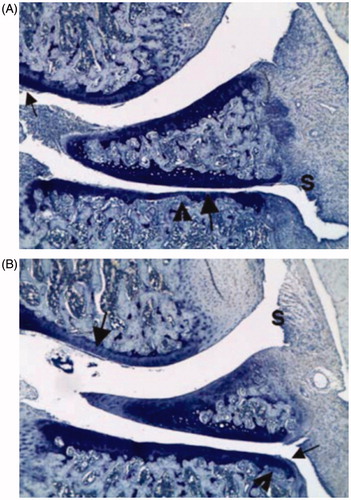 Figure 5. Effects of NEM on morphologic pathology knee joint. Panel A: Knee from a arthritis vehicle control animal (with the approximate mean summed score for the group; animal 1, right knee) has severe inflammation (S) with mild pannus (small arrow), cartilage damage (large arrow), and bone resorption (arrowhead). Panel B: Knee from an arthritic animal treated with NEM-8011510 (with the approximate mean summed score for the group; animal #9, right knee) has moderate inflammation (S) and mild cartilage damage (large arrow) with very minimal pannus (small arrow) and bone resorption (arrowhead). Each slide was evaluated at 50× magnification.