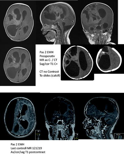 Figure 3. Eight-month-old girl presenting with increased intracranial pressure (vomiting, tense fontanel, sunset sign). MRI demonstrated multicystic tumor that turned out to be a WHO grade 3 ependymoma in the right hemisphere, with enhancement also in the posterior fossa and the spinal canal. After major tumor resection in the right hemisphere and intrathecal as well as systemic chemotherapy (according to HIT-2000 protocol), a small residual tumor progression was observed later in 2015. Repeated resection demonstrated a glioblastoma component along with elements of ependymoma (WHO grade 3–4). Radiotherapy was therefore given (54 Gy) along with Temodal for some months. Four years later and after a total follow-up of eight years, she is tumor-free according to MRI, although with severe hemiparesis and has mostly only non-verbal communication. The Barthel Index is 50, and she is in the need of special schooling.