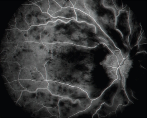 Figure 3 Fluorescein angiography 2 months after intravitreal bevacizumab injection (mid phase) showing drop out of retinal capillaries throughout the entire posterior pole.