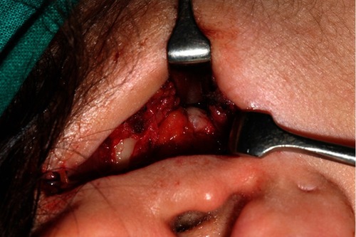 Figure 4 Intraoperative view of the temporomandibular joint showing a dermis interposition graft after diskectomy.
