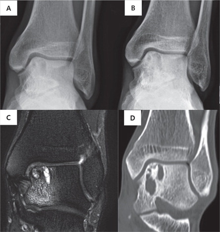 Figure 4. A 48-year-old man with OCL. (A) Initial standing radiograph and (C) MRI. (B) Standing radiograph and (D) CT at 3.8-year follow-up. Although the lesion size increased, the AOFAS ankle–hindfoot score improved from 71 to 80.