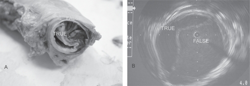 Figure 2 Aortic dissection. Actual specimen (A) and intravascular imaging (B) show both the true and false lumen.