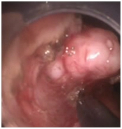 Figure 2 Submucosal dissection of the leiomyoma started along the lower border of the lesion and was facilitated by the endoscopic cap.