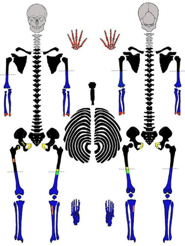 Figure 1. Skeletal inventory of Joseph Henry Loveless presented as a case timeline. Gray elements indicate those never recovered. Black elements were recovered in 1979. Blue elements were recovered in 1991. Red areas were cut and sampled by Federal Bureau of Investigation (FBI) 1979 and not present for current analysis. Yellow areas indicate cuts made in 1979 by the Smithsonian. The green area indicates the histological section made by Idaho State University (ISU) 2019. The orange areas indicate the bone window made on the right femur in 2015 for DNA sampling (sent in 2017), and the 2019 DNA sampling of the left tibia. Dotted lines indicate perimortem dismemberment locations.