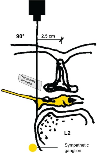 Figure 5 Paravertebral blockade (PVB): needle insertion, cross-section.