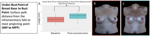 Figure 14. The under-bust point of breast base to bust point measurement (inframammary fold to most projecting point) for the participants who underwent bilateral implant-based reconstruction significantly increased after implant-based reconstruction (right breast: p = 0.03, left breast: p = 0.005). (A) Boxplot (median and interquartile range) of the under-bust point of breast base to bust point measurement at baseline and post-reconstruction for the right breast (left was similar). (B) The under-bust point of breast base to bust point measurement on an exemplar patient at baseline. (C) The under-bust point of breast base to bust point measurement on the same patient post-reconstruction.