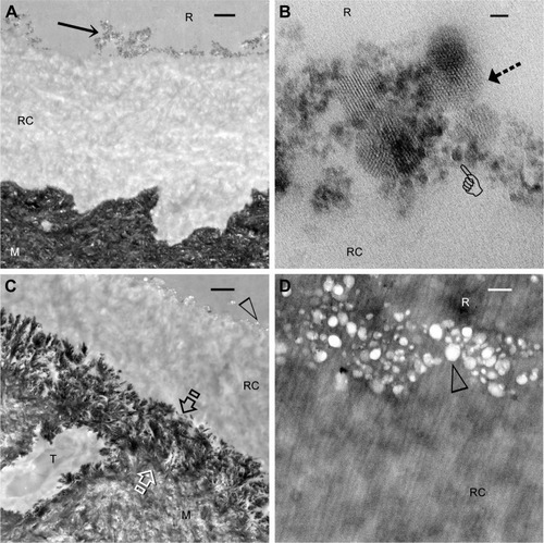 Figure 6 Unstained TEM images taken from sections of hydrophilic resin (R)-infiltrated, partially mineralized hard tissues (bovine dentin) showing collagen remineralization and silicon dissolution.Notes: Low magnification of a PAH-ACP@pMSN pretreated specimen stored in TBS for 24 h showing a 5 μm thick band of resin-infiltrated collagen matrix (RC). The PAH-ACP@pMSN nanoparticles were located along the surface of the 3-D collagen matrix (arrow). M: mineralized hard tissue. Bar: 1 μm (A). High magnification of image A showing release of mineralization precursors (pointer) from the pMSN (arrow). Bar: 20 nm (B). Low magnification of a PAH-ACP@pMSN-pretreated specimen stored in TBS for 3 months. Bar: 1 μm. The resin-sparse bottom of the collagen matrix was heavily mineralized (between open arrows). The pMSN that were originally present on top of the resin infiltrated collagen matrix (RC) were completely solubilized (open arrowhead). T: tubule-like channels characteristic of the dentin (C). High magnification images of image C, showing voids (open arrowhead) between the hydrophilic resin (R) and the resin-infiltrated collagen matrix (RC) that were originally occupied by PAH-ACP@ pMSN. Bar: 100 nm (D).Abbreviations: PAH-ACP, poly(allylamine)-stabilized amorphous calcium phosphate; PAH-ACP@pMSN, PAH-ACP loaded pMSN; pMSN, expanded-pore mesoporous silica nanoparticles; TBS, tris(hydroxymethyl)aminomethane-buffered saline; TEM, transmission electron microscopy.