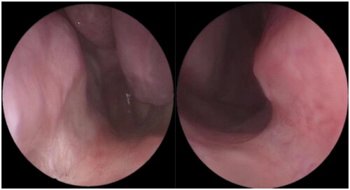 Figure 5. Both nasal floor flaps healed well, and cyst recurrence was not seen.