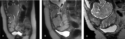 Figure 4 MRI images in placenta accreta spectrum. (A and B) White arrows show dark intra-placental bands on T2-weighted images. (C) White arrows indicate the uterus bulging into the bladder.