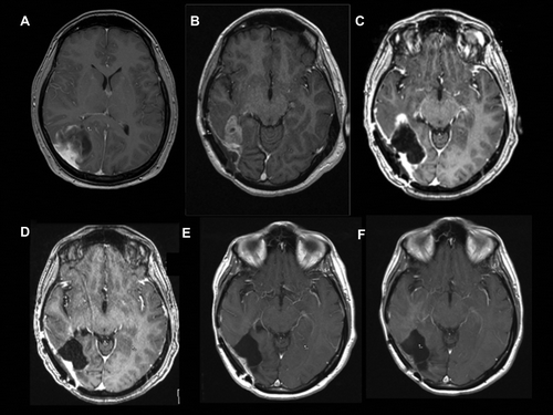 Figure 1. T1, contrast enhanced, axial MRI. A: anaplastic pleomorphic xanthoastrocytoma at diagnosis (17.1.2012), contrast enhanced tumorwith cystic component, B: prior to 3th surgery (26.11.2013), C: one month after 3th surgery (27.12.2013), D: five weeks on vemurafenib (31.1.2014), E: five months on vemurafenib (14.5.2014), F: one year on vemurafenib (22.1.2015).