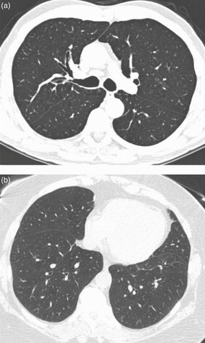 Figure 3  (a) Axial CT image in a subject with GOLD Stage 1 COPD, where reviewers scored visual bronchial wall thickening, but wall area% of segmental bronchi was 55%. CT shows evidence of thickening of the bronchial walls, but associated moderate dilation of the bronchial lumens resulted in normalization of the wall area% value. (b) Axial CT image in a smoking control subject where reviewers scored no bronchial wall thickening, but wall area% of segmental bronchi was 63%. Although the bronchial walls appear visually normal, the bronchial lumens are relatively small, and this might have resulted in artificial elevation of the wall area% value.