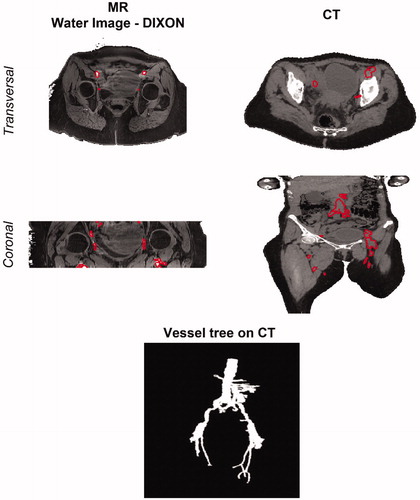 Figure 4. Vessel definition on MR and CT scans. Vessel delineations are shown on the transverse and coronal cross-sections of water image generated with the DIXON method (left) and on the HT-CT scan (right). These delineations were manually adjusted after MR to CT registration (not shown). At the bottom, a 3D rendering of the final vessel tree is shown.