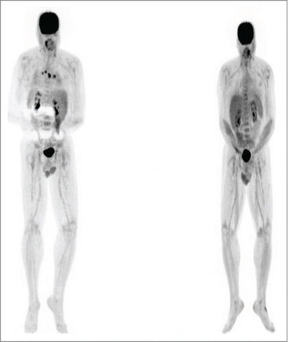 Figure 4. Patient 3. PET/CT in August 2013 (left, prior to BRAF inhibitor therapy) showed intensely FDG avid lymph nodes post ipilimumab which were biopsy confirmed metastatic melanoma. PET/CT in November 2013(right, after trametinib) showed the previously described intensely FDG avid lymph nodes and nodules had entirely resolved. The skin nodules on his scalp also resolved. The trametinib was gradually weaned and stopped by 5/14. He has remained in complete remission to date off therapy.