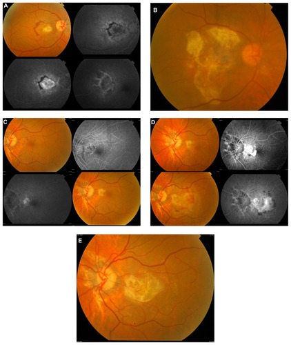 Figure 1 Case 1. (A) Active subfoveal CNV membrane OS with subretinal hemorrhage connected to area of angioid streaks. Intravenous fluorescein angiography showed classic subfoveal choroidal neovascular membrane with leakage at the end of the study. (B) Healed CNV OS. (C) Active juxtafoveal CNV emanating from angioid streaks OD with subretinal hemorrhage. Lower left picture shows response to treatment. (D) Active subfoveal CNV OD emanating from the previous CNV. (E) Healed CNV OD.