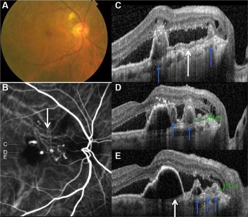 Figure 4 The right eye of a 71-year-old male (case 11) with bilateral idiopathic choroidal folds and polypoidal choroidal vasculopathy initially diagnosed with age-related macular degeneration.