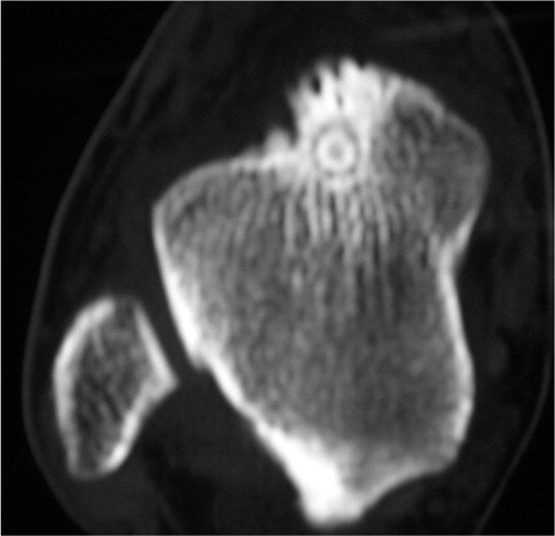 Figure 5. Case 2. The talar osteoid osteoma. Appearance on a CT view.