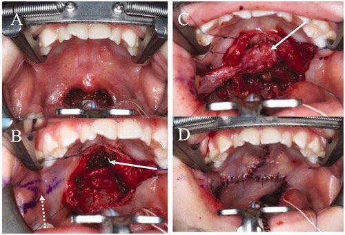 Figure 2. The first operation. (A) Intraoral findings. There are no features of SMCP. (B) Separation of the abnormal attachment of the LVPM from the PNS and soft palate elongation on the nasal side. A space occurs after posterior elongation (white arrow). The pedicle of the BMMF is denuded (white dotted arrow). (C) The space is filled by the right BMMF (white arrow). (D) After the first operation.