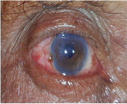 Figure 2 Showing focal corneal edema along paracentral central area POD1.