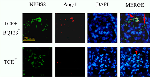 Figure 16 The location of Ang-1 (×400). Ang-1 was mainly expressed on podocytes. Red arrow: podocytes.