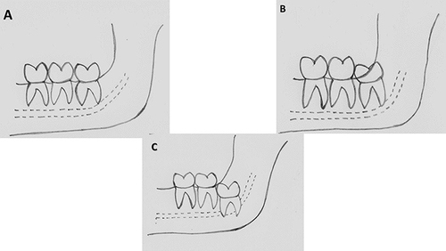 Figure 3 Pell and Gregory Classification. (A) Class 1. (B) Class 2. (C) Class 3.