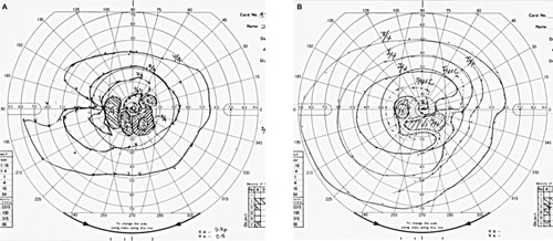 Figure 2 Visual field tests using a Goldmann perimeter.