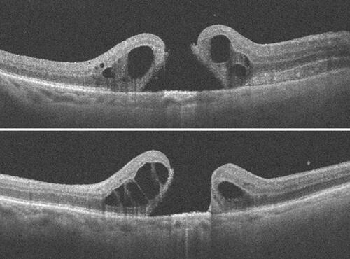 Figure 3 FTMH, with accumulation of large intraretinal cystic fluid and ERM occurring three weeks after vitrectomy for the removal of sub ILM hemorrhage.