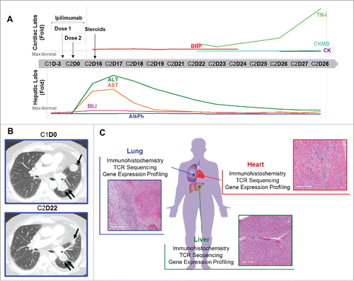 Figure 1. Autoimmune myocarditis in a patient with melanoma treated with ipilimumab. (A) Cardiac and hepatic function testing results over the course of therapy with ipilimumab. Graphs show results as fold-change for BNP, TN-I, CKMB, CK, BILI, ALT, AST, and AlkPh; horizontal dashed line indicates the upper limit of normal for each test. X-axis, day of ipilimumab treatment cycle (Cycle 1 = C1, Cycle 2 = C2). Arrows indicate the timing of ipilimumab doses and the start of corticosteroids. (B) Computerized tomography images of the lung metastasis before ipilimumab and after 2nd treatment. (C) Experimental plan and histological images of the heart, lung, and liver which were studied by immunohistochemistry, TCR sequencing, and gene expression profiling.