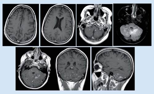 Figure 4. MRI brain revealed significant regression regarding the previously seen abnormal cerebral white matter signal intensity and brain stem with markedly regression of the pattern of enhancement in postcontrast study (May 2017).However, there was a mild increase in the size of the previously seen cerebellum abnormal signal intensity.