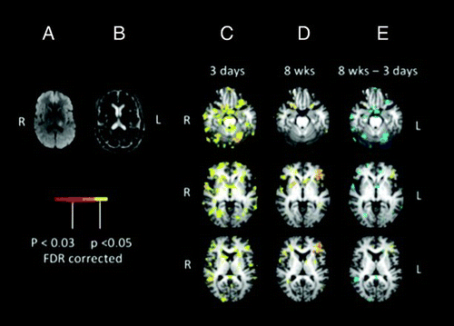 Figure 4. DWI (Panel A) and apparent diffusion coefficient (ADC; Panel B) sequences show a subcentimetre area of diffusion restriction in the left thalamus for Participant 2. Functional magnetic resonance imaging (fMRI) data registered in Montreal Neurological Institute (MNI) space shows areas of activation associated with silent word generation at Day 3 (Panel C) and 8 weeks (Panel D). fMRI activation maps are false discovery rate (FDR) corrected for multiple comparisons and are displayed with a threshold of p < .05. A difference statistical map (Panel E) shows activation that is greater at 8 weeks than 3 weeks in yellow, and activation that is greater at 3 weeks than 8 weeks in blue. This last map shows change in statistical maps as a function of time. [To view this figure in colour, please see the online version of this journal.]