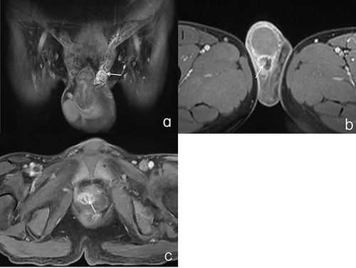 Figure 3 (a) Pelvic T1WI fat-suppressed sequence enhancement scan shows significant thickening of the left spermatic cord in the coronal position, with significant enhancement in the enhancement scan (white arrow); (b) Pelvic T1WI fat-suppressed sequence enhancement scan shows a right epididymal nodule in the transverse section, with circular enhancement (white arrow) in the enhanced scan; (c) Pelvic T1WI fat-suppressed sequence enhancement scan shows annular enhancement in the prostate (white arrow) at the transverse position.