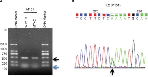 Figure 4 ARMS amplification from fetal amniotic fluid DNA (III:2) by primers CHM-WT2 (WT2) and Common primer CHM-C3, and primers CHM-MT and CHM-Common.