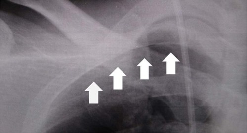 Figure 1 Chest X-ray film immediately after the puncture.