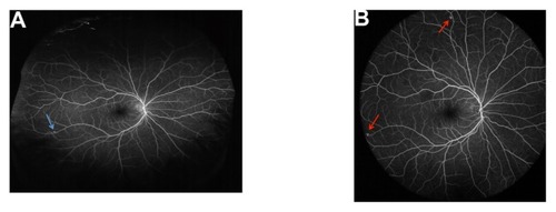 Figure 3 Ultra-widefield fluorescein angiogram of the right eye of the same patient with Von Hippel-Lindau syndrome, shown in Figure 2. (A) Optos® Optomap® (Optos PLC, Dunfermline, UK); (B) Heidelberg Spectralis® (Heidelberg Engineering, Heidelberg, Germany).
