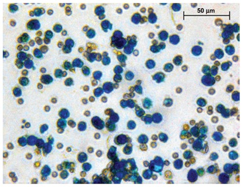 Figure 2 Endorem+ CD133+ stem cells.Notes: CD133+ stem cells labeled with iron oxide nanoparticles (Endorem). Cells were stained with Prussian blue and taken at 40× magnification.