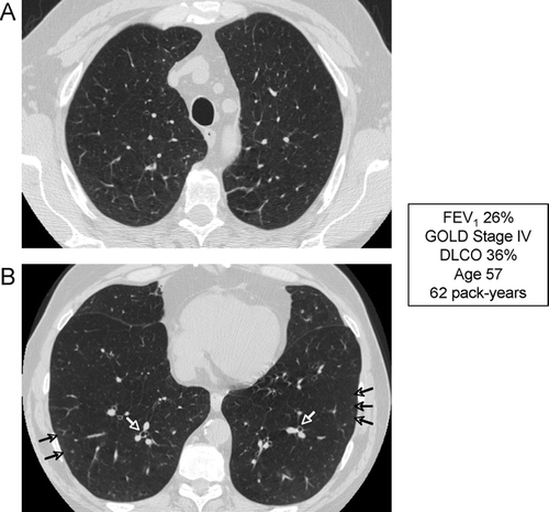 Figure 18 Radiographic appearance of airways disease predominant COPD associated with severe airflow limitation. (A) demonstrates mild upper lobe centrilobular emphysema, while (B) shows very minimal emphysema in the lower lobes but moderate airway wall thickening indicating bronchitis (white arrows) and centrilobular thickening suggesting respiratory bronchiolitis (black arrows).