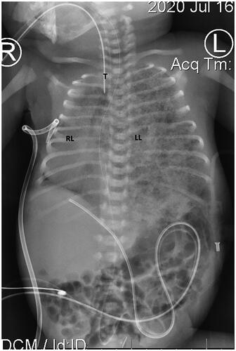 Figure 4. Plain film radiographs obtained July 2020 (Day 1). AP projection. Right-sided deviation of the trachea (T), endotracheal tube in situ. Hypoplastic right lung RL. Coarse opacities in left lung (LL). Protuberant abdomen due to ascites secondary to fetal hydrops.