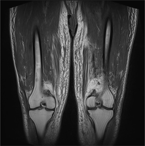 Figure 2 Magnetic resonance imaging of pelvis and legs showed bilateral lower limb subcutaneous edema with prominence of the dermal thickness and patchy tethering with increased T2 signal of the quadriceps and adductor muscle groups.