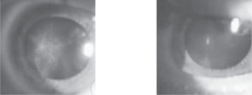 Figure 4 The pictures show the treatment of human cataract in the older subject with the eye drops of 1% Can-C™ for the period of 5 months. The left image shows the appearance of cataract which resembles a bat in its form and the right image shows that this opacity has disappeared after the cited period after treatment with n-acetylcarnosine is completed. The lens has become clearer.